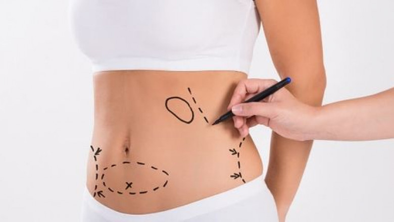 Your Recovery from Tummy Tuck Surgery