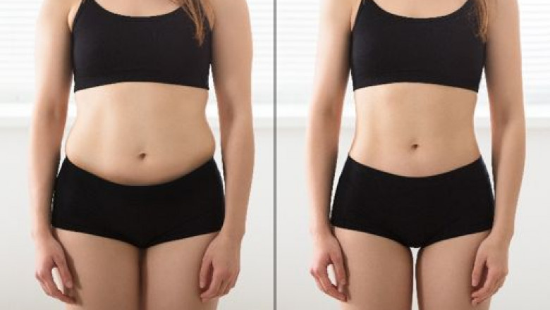 After Liposuction - What to Expect