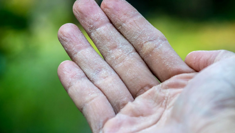 Eczema Therapeutics Industry Insights, Trends, and Forecasts to 2027
