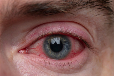 GET RID OF RED EYES WITHOUT EYE DROPS
