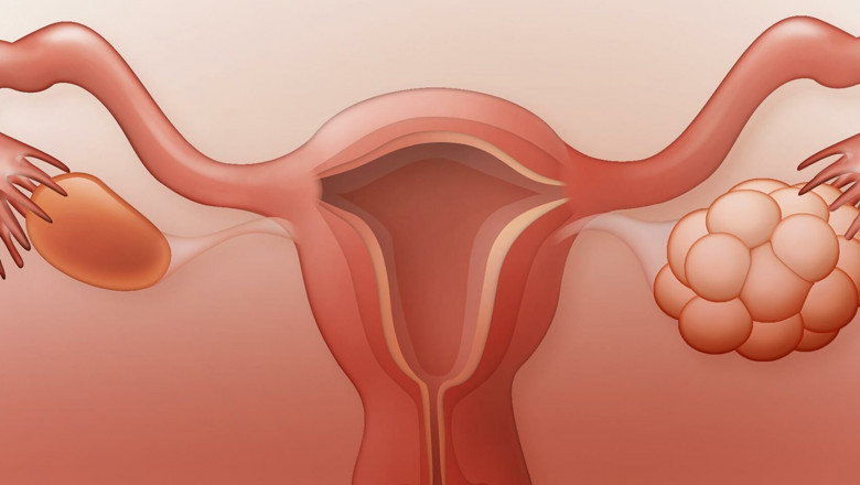Global Polycystic Ovary Syndrome Treatment Market Restraints