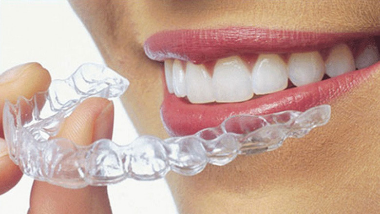 Clear Aligners Market Analysis & Forecast by 2030