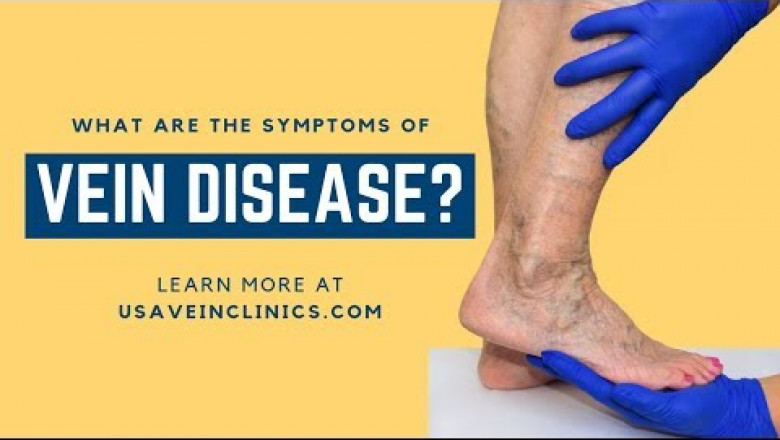 The Symptoms of Vein Disease