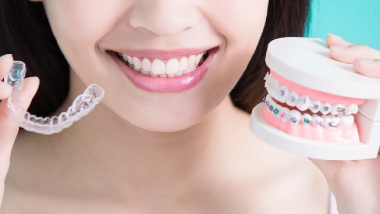 Invisalign Can Fit the Teeth Perfectly