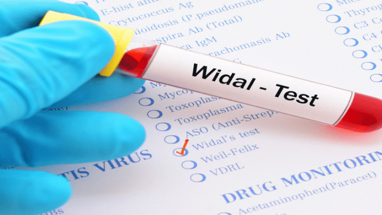 Typhoid Antibody Testing Market: Global Demand Analysis & Opportunity Outlook 2031