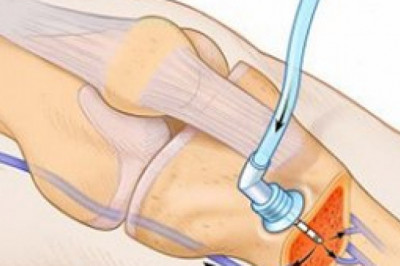 Intraosseous Device Market Trends, Research, and Analysis for the Forecast Period 2022-2030