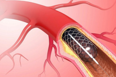 Plaque and thrombus are easily removed from damaged arteries by atherectomy devices