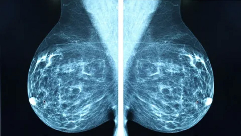 Breast Imaging Market Outlook - Size, Share, Demands and Dynamics, Forecast 2022-2030