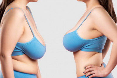 Differences between mammoplasty and mastopexy