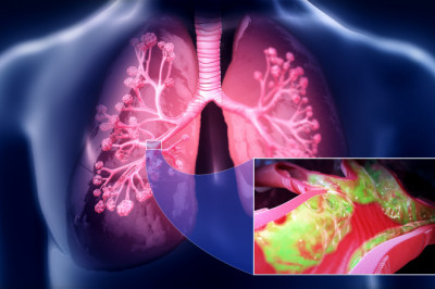 Global Pulmonary Edema Therapeutics Market Overview