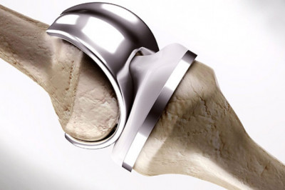 When Bone Grafting is Not Practicable, Bone Replacement Products are Commonly Employed