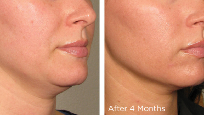 Ultherapy Non-invasive facelift procedure explained