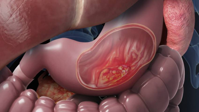 What Is Stomach Cancer? Is it Curable? | Dr. Pratik Patil