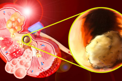 Global Urolithiasis Management Devices Market Opportunities