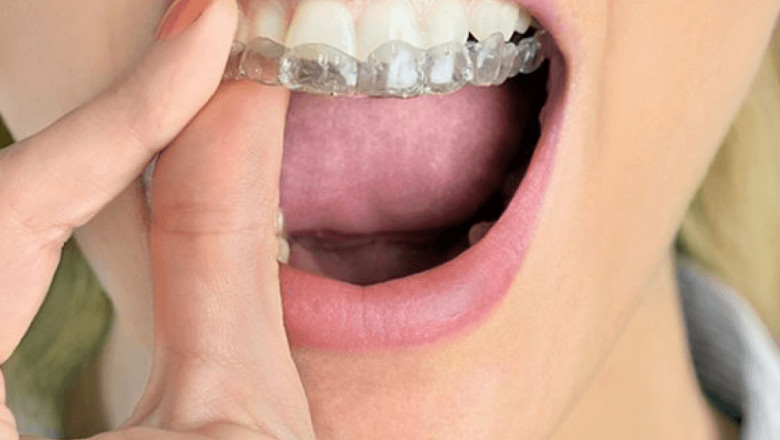 Health Benefits of Straight Teeth | Tower House Dental Clinic