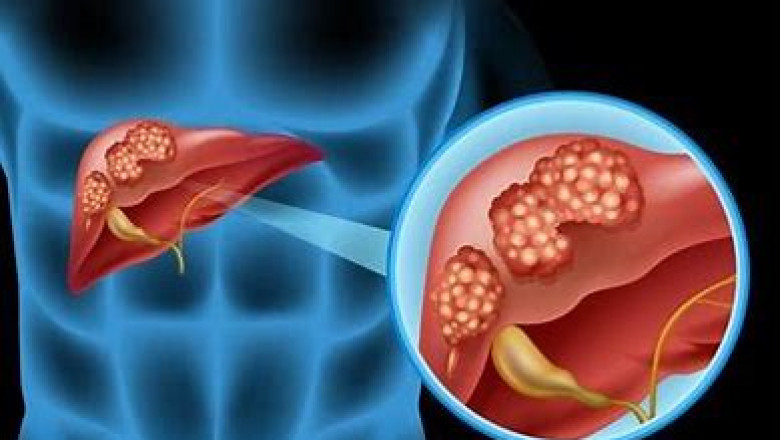 Liver Cancer Diagnostic Market 2022 Size & Forecast Research Report