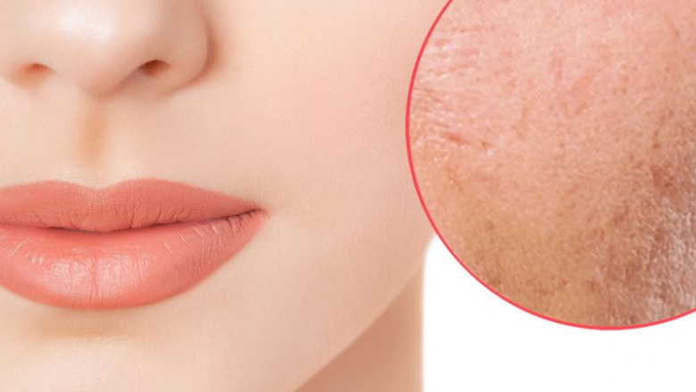How Effective Is Laser Acne Therapy? Can You Permanently Get Rid of Acne With It?