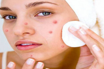 Acne and Pimples Treatment - Herbal Medicine For Blood Clean?