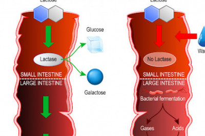 Lactose Intolerance: Causes, Symptoms And Remedies