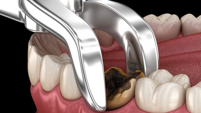 What Can I Do Instead of Tooth Extraction?