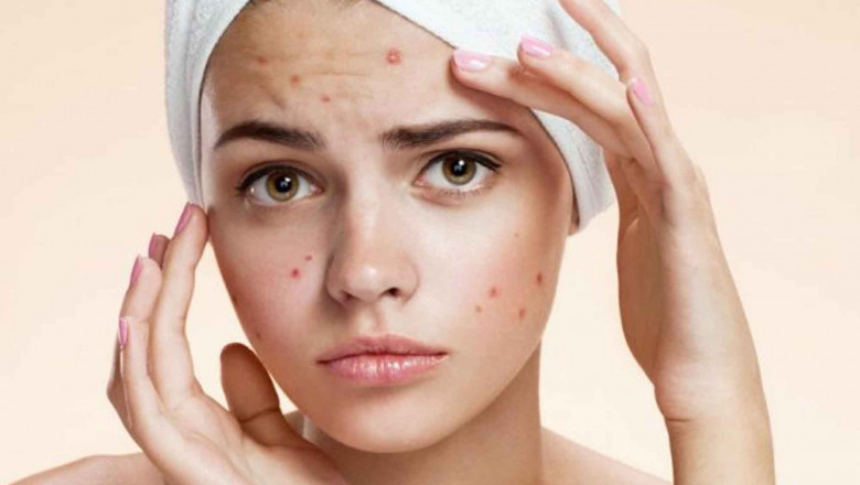 Acne and Pimples - Herbal Medicine For Blood Clean ?