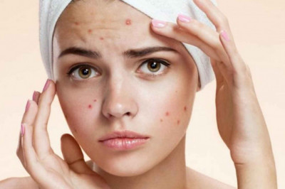 Acne and Pimples - Herbal Medicine For Blood Clean ?