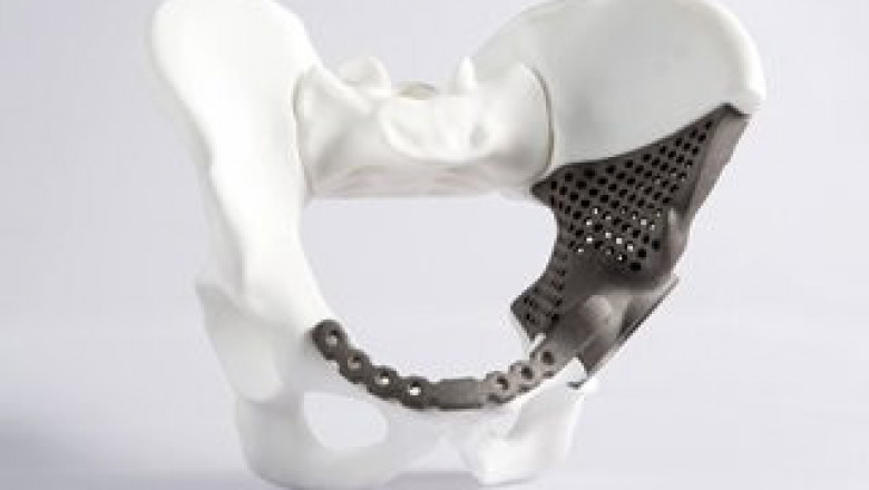 Orthopedic 3D Printing Equipment Market Report 2022-2028 | Industry Analysis By Top Key Players