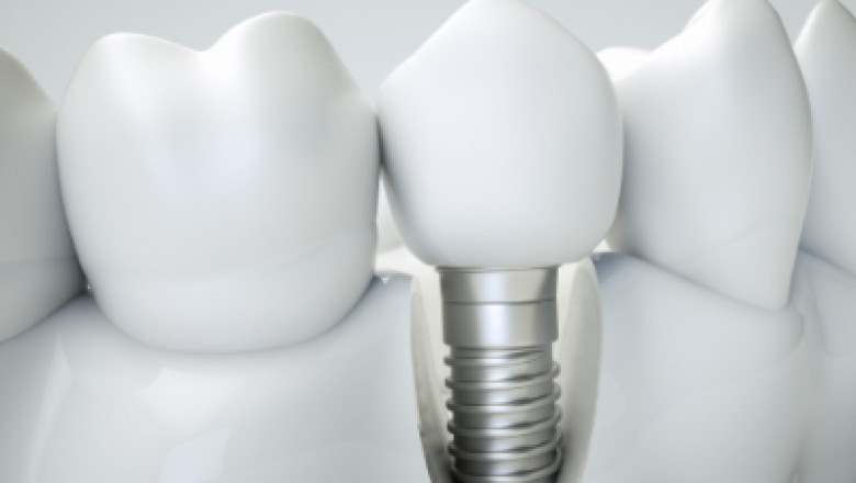 Consider These 5 Factors Before Getting Dental Implants.