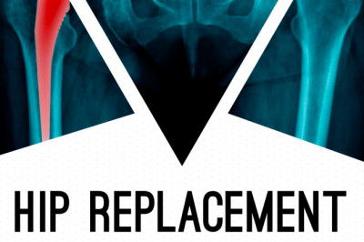 Dr Anoop Jhurani Best Hip Replacement Doctor in Jaipur, India