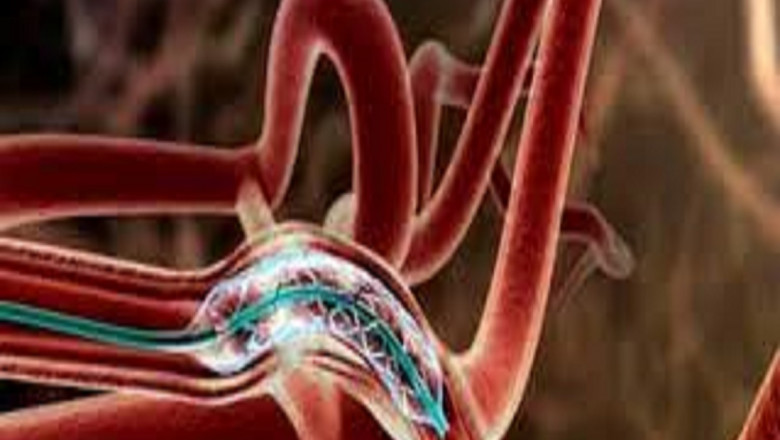 Intracranial Stents Market 2022 Major Key Players and Industry Analysis Till 2028