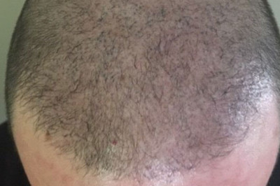 Restore Your Lost Self-Esteem with Scalp Micropigmentation