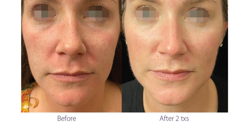With Anti-Wrinkle Treatment, Fine Lines Can Be Reduced.
