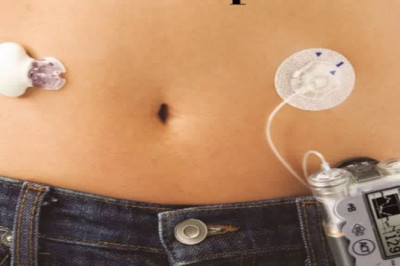 An Tubeless Insulin Pump Is a Device That Administers Insulin Directly Into the Body Through a Tiny Tube Implanted Beneath the Skin
