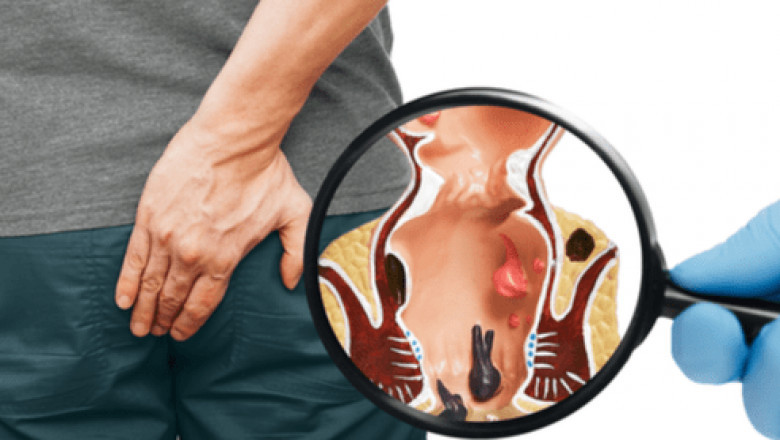 How to Treat Bleeding Piles at Home with Topical Solutions