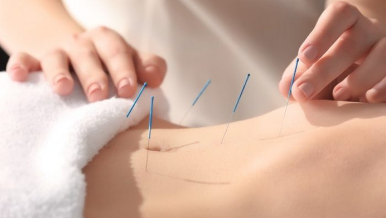Acupuncture Clinic - Find Acupuncturists in Perth