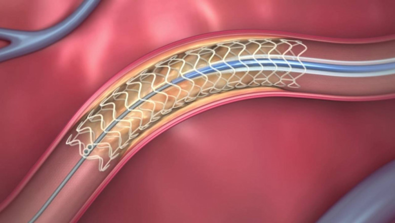 Global Coronary Artery Disease Therapeutics Market Opportunities