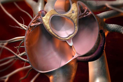 Global Patent Foramen Ovale (PFO) Closure Devices Market Restraints