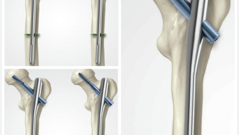 The Veterinary Orthopedic Implants Market: Global Industry Trends, Share, Size, Growth, Opportunities, and Forecast, 2020-2027