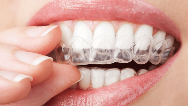 What Does The Dentist Do For Deep Cleaning Teeth?