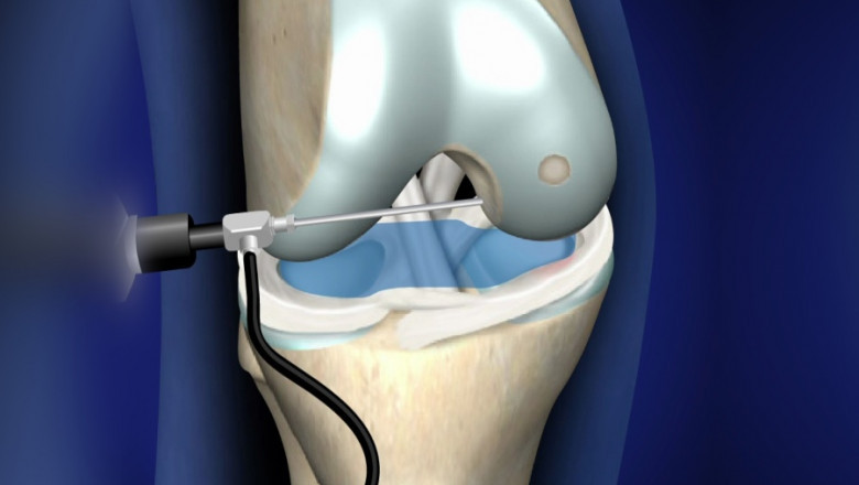 Global Arthroscopy Procedures and Products Market Restraints