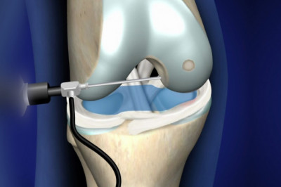 Global Arthroscopy Procedures and Products Market Restraints