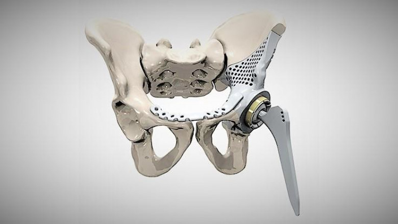 The 3D Printed Medical Implants Used For Surgical Equipment Designed Specifically For The Anatomy Of A Patient