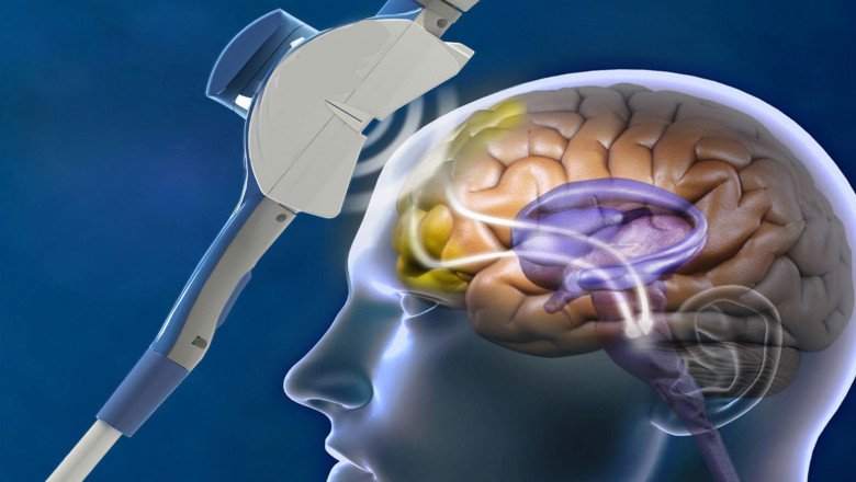 The Use Of Deep Brain Stimulation Devices Are Employed In The Treatment Of Many Neurological Conditions