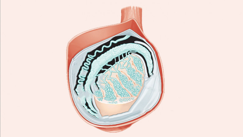 Biopsy IVF Treatment in Hyderabad