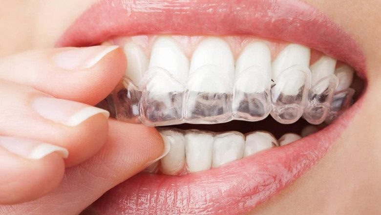 Invisalign Braces Adelaide