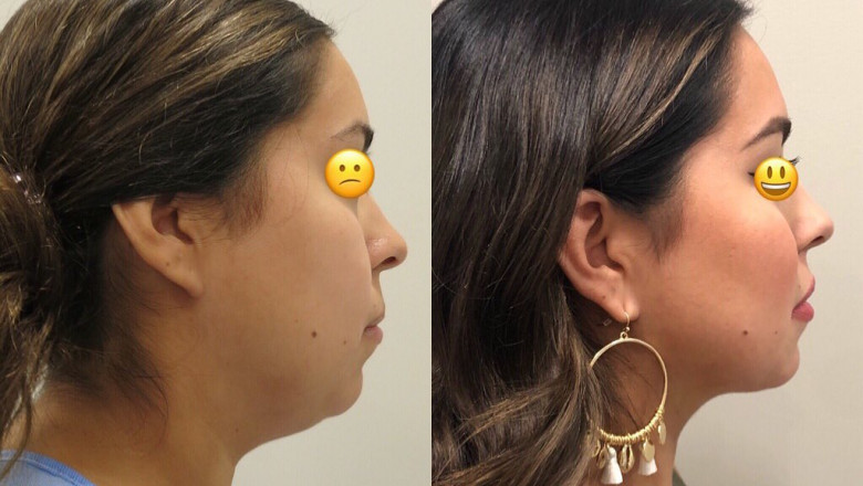 Is Liposuction Suitable For Arms?