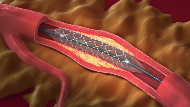 Patients With Narrow Arteries are Typically Offered Angioplasty Balloons
