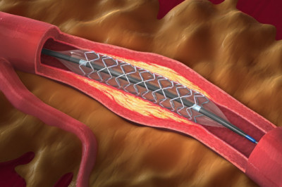 Patients With Narrow Arteries are Typically Offered Angioplasty Balloons