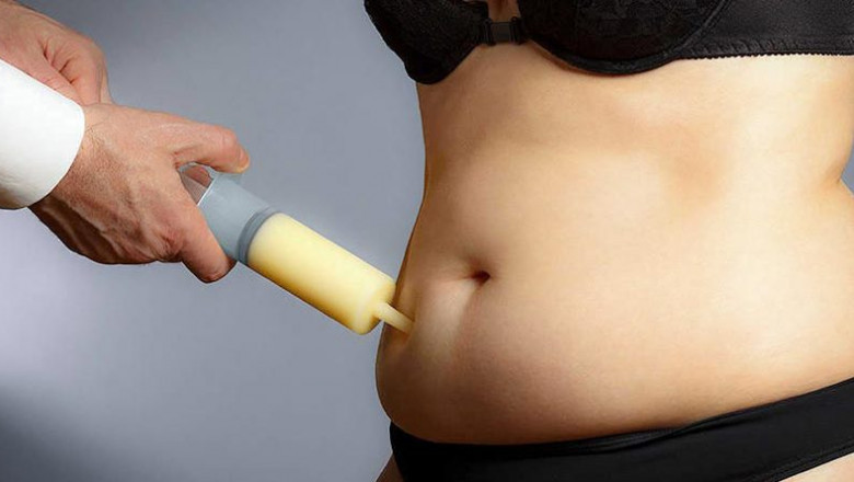 The Best Liposuction services in Mohali, India | Skin & Sculpt