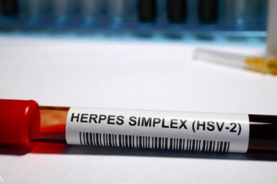 What are the Herpes Simplex Virus (HSV) Vaccines?